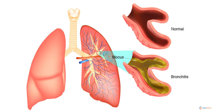 Bronchitis