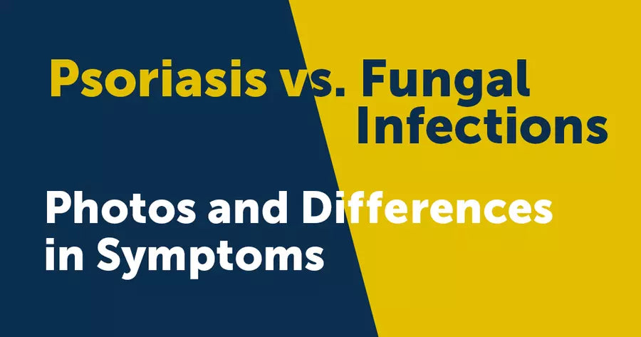 Is It Psoriasis or a Fungal Infection?