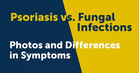 Is It Psoriasis or a Fungal Infection?