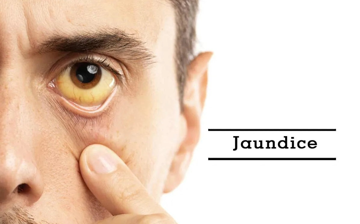 ayurvedic-jaundice-treatment