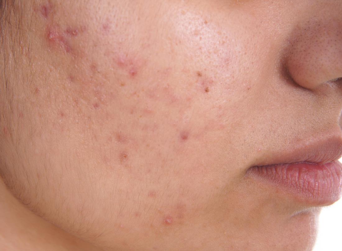 Acne & Pimples