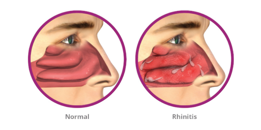 Allergic Rhinitis