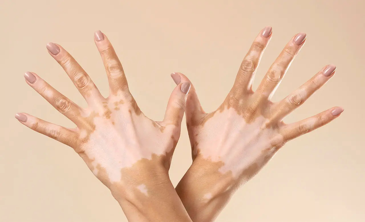 Vitiligo (Leucoderma) & Skin Pigmentation Care