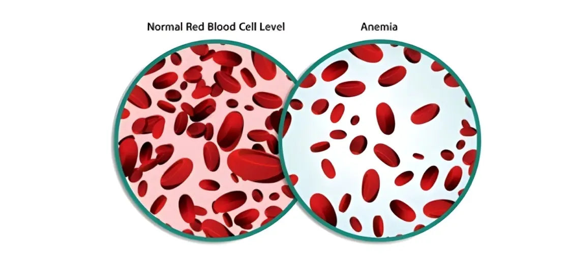 Anemia