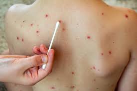 Chicken Pox