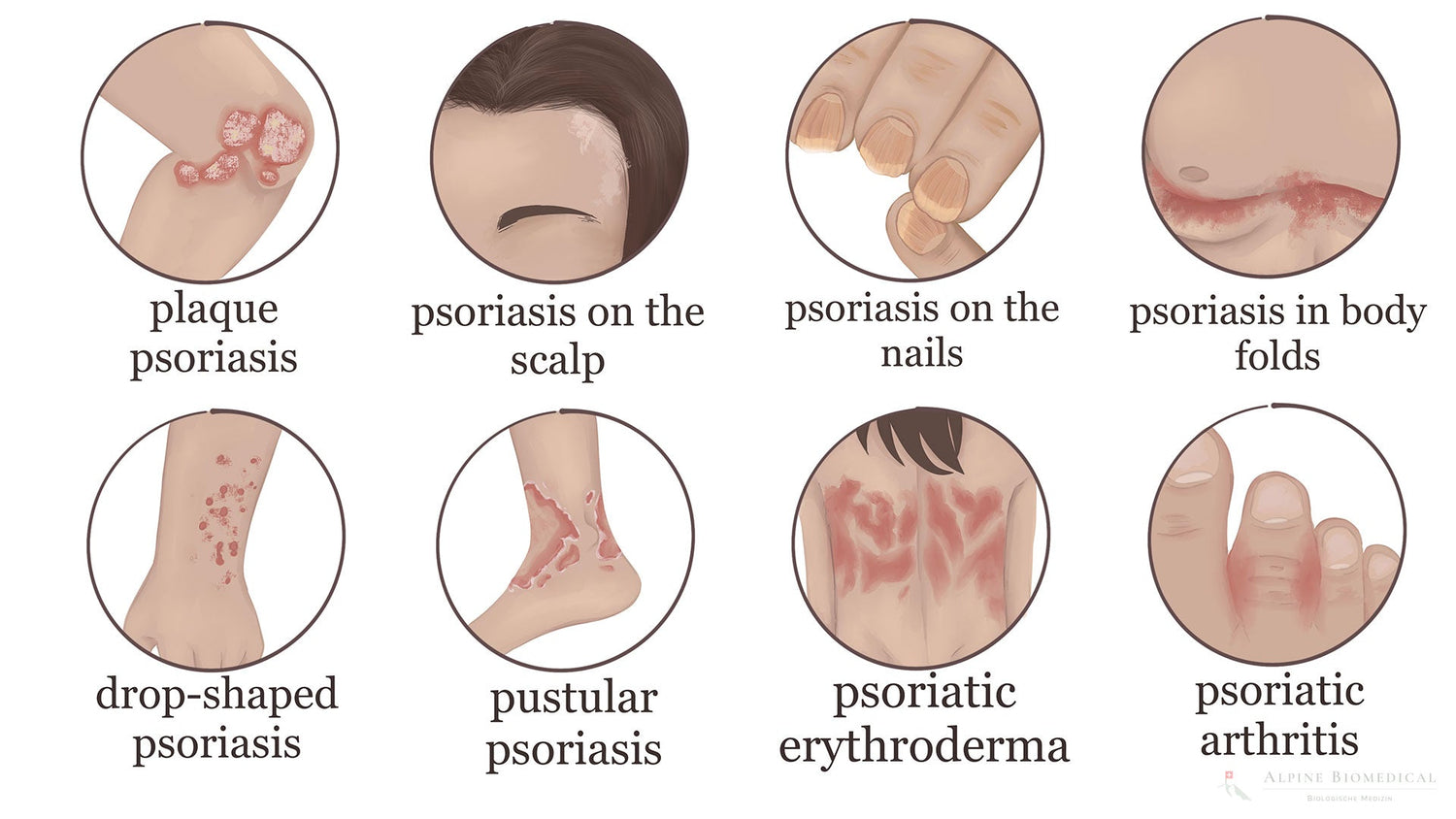 Psoriasis