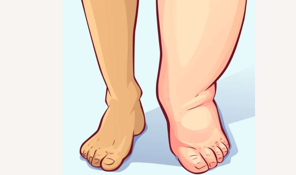 Swelling/ Edema