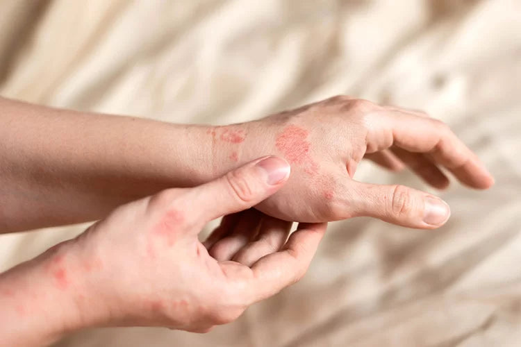 Skin Health, Psoriasis & Blood Purification
