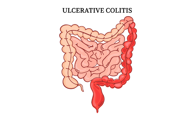 Ulcerative Colitis