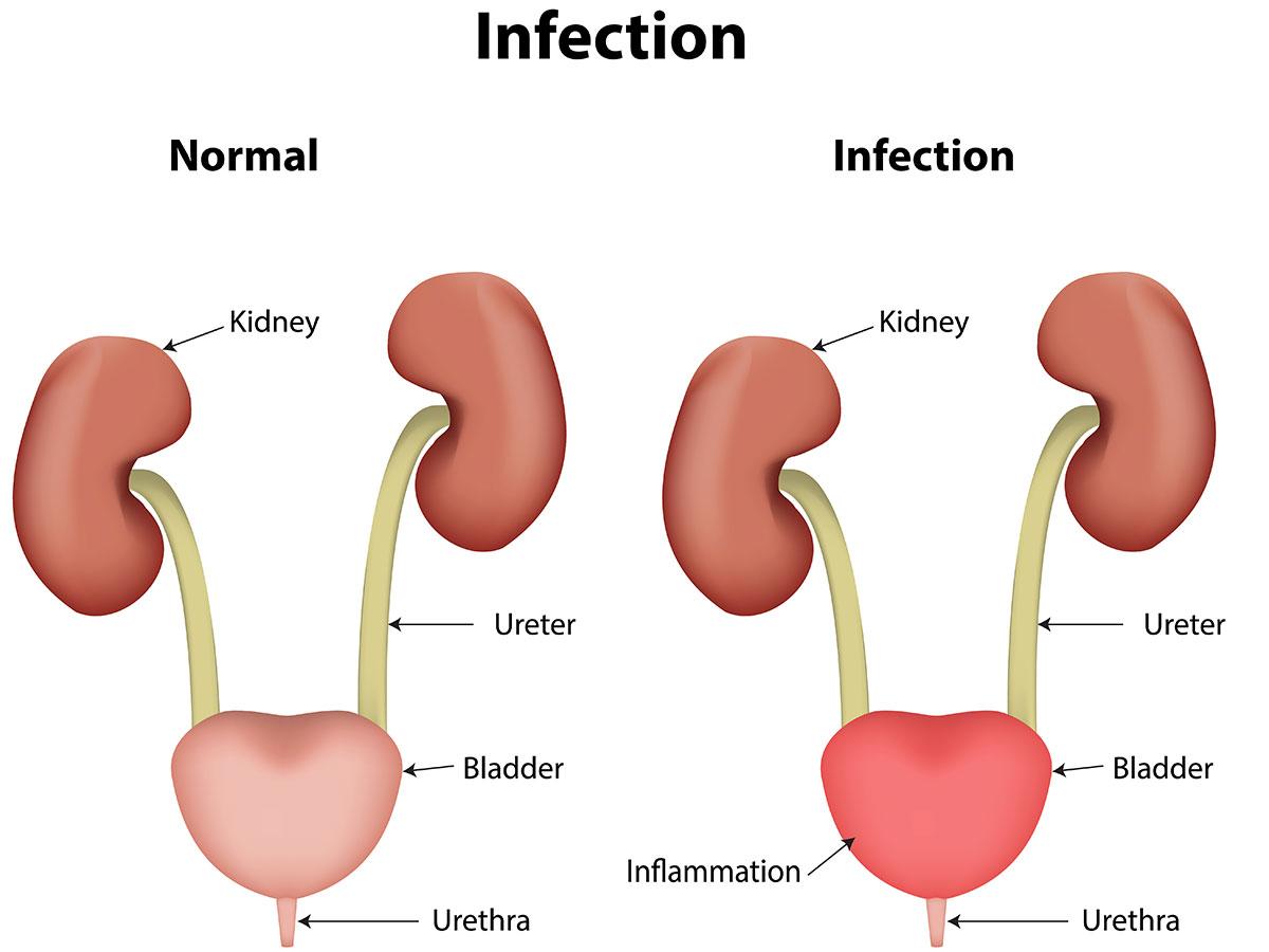 Urinary Tract